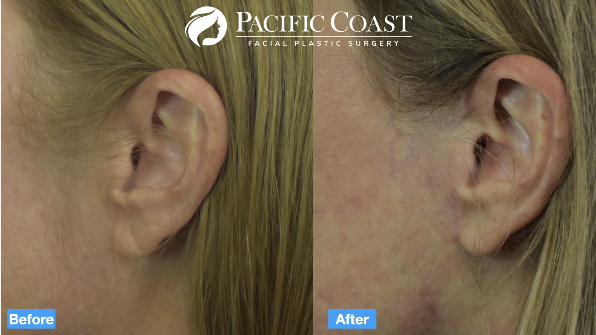 earlobe incision .001.jpeg